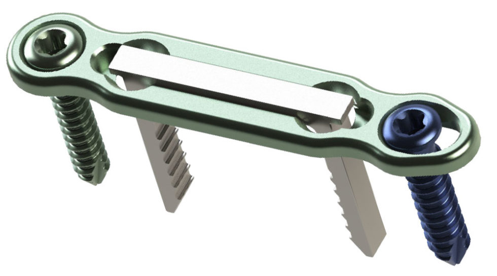 DynaForce Staple Compression Plates - CrossRoads Extremity